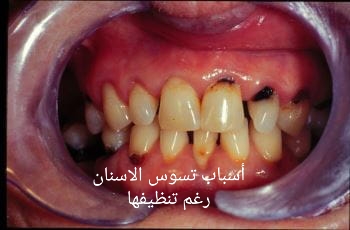أسباب تسوس الاسنان رغم تنظيفها من منصة تدريبكم