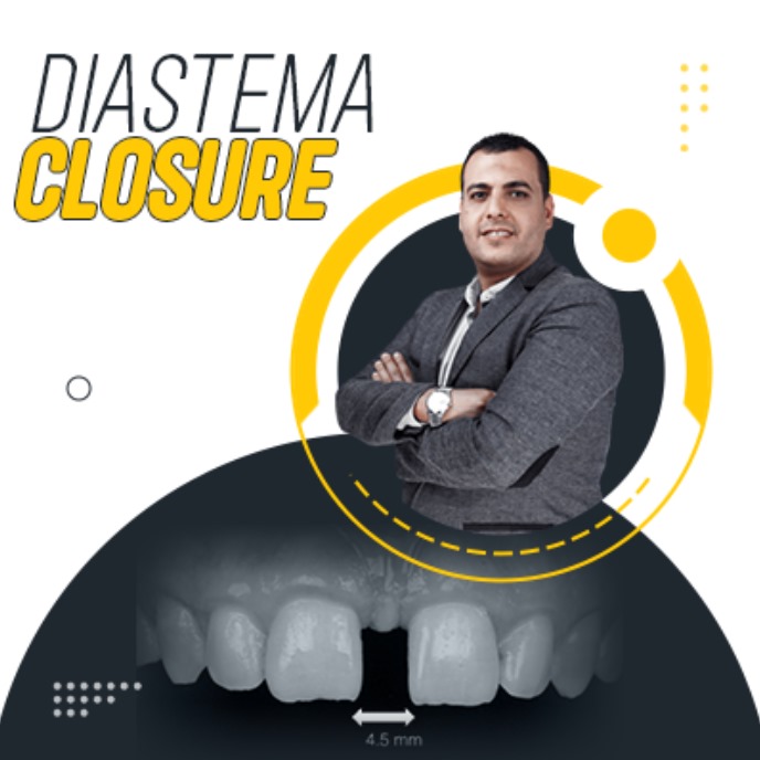 Diastema Closure